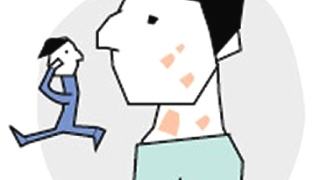 小孩牛皮癣怎么治疗